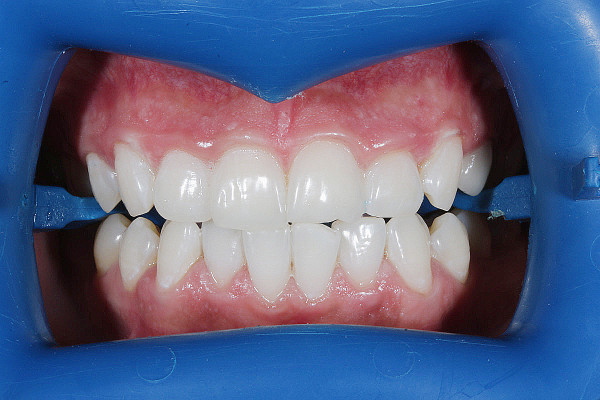 зубы после отбеливания ZOOM 4